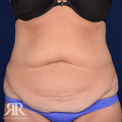 Tummy Tuck