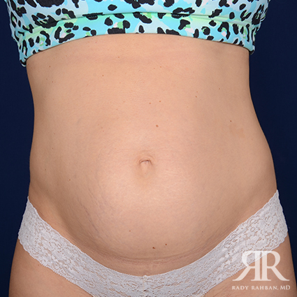 Tummy Tuck