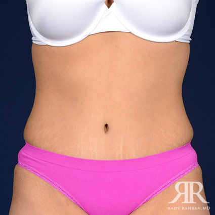 Tummy Tuck