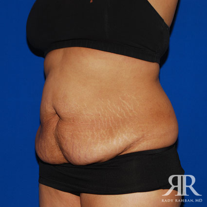 Tummy Tuck