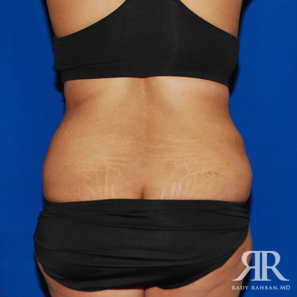 Tummy Tuck