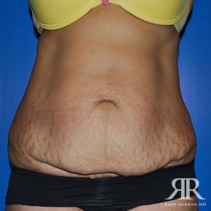 Tummy Tuck