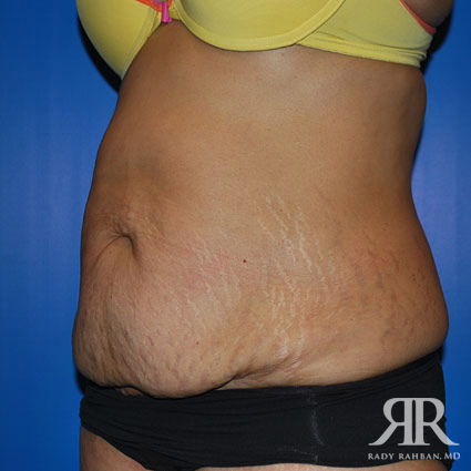 Tummy Tuck