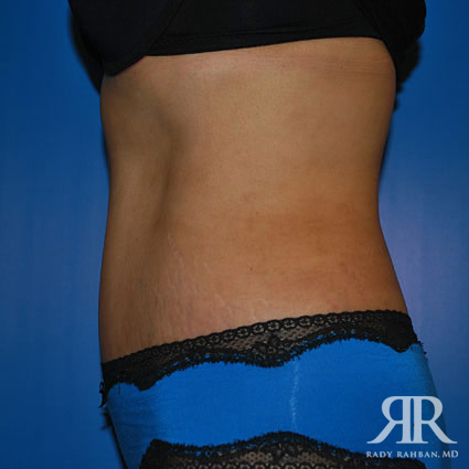 Tummy Tuck