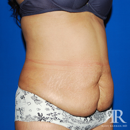 Tummy Tuck