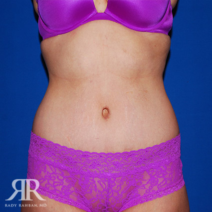 Tummy Tuck