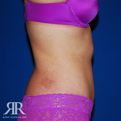 Tummy Tuck