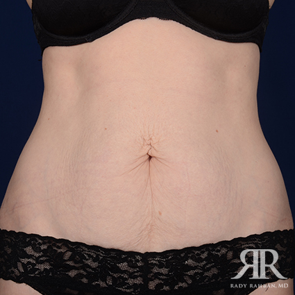 Tummy Tuck