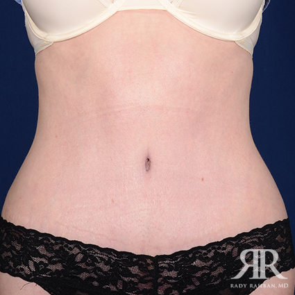 Tummy Tuck