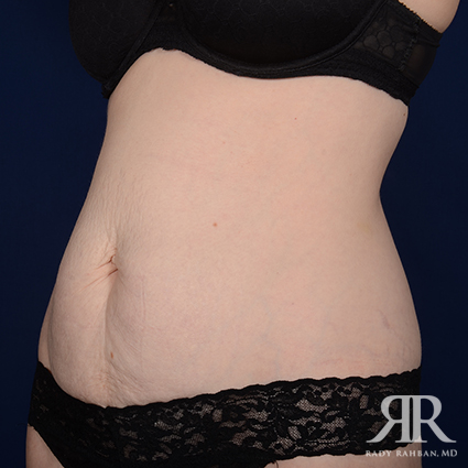 Tummy Tuck