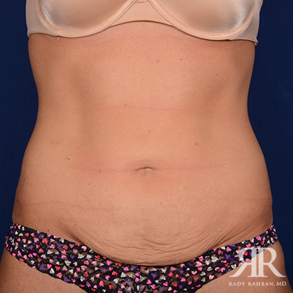 Tummy Tuck