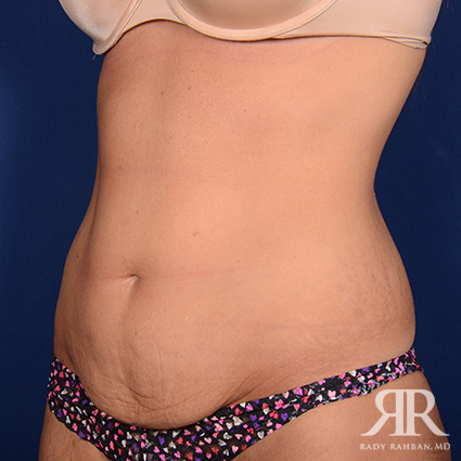 Tummy Tuck