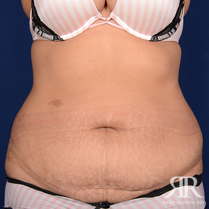 Tummy Tuck