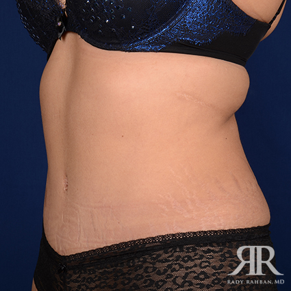 Tummy Tuck