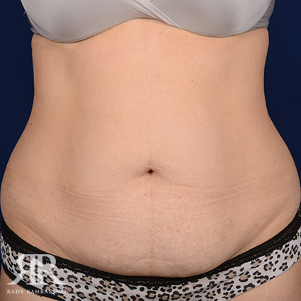 Tummy Tuck