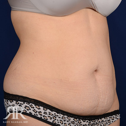 Tummy Tuck