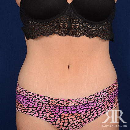 Tummy Tuck