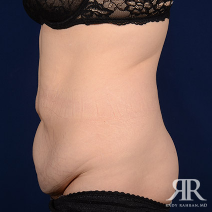 Tummy Tuck