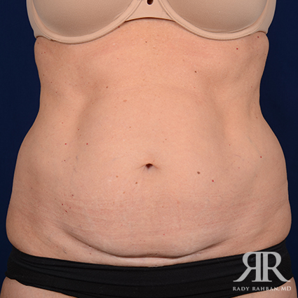 Tummy Tuck