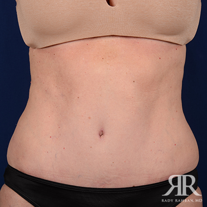 Tummy Tuck