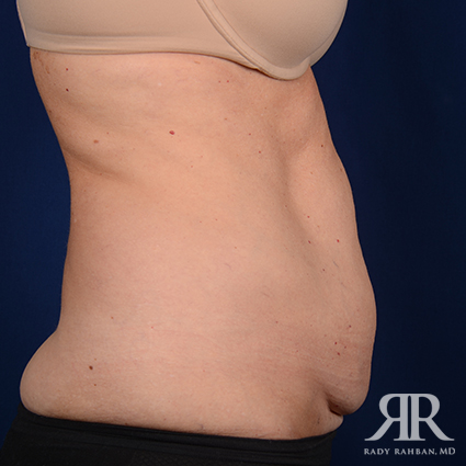 Tummy Tuck