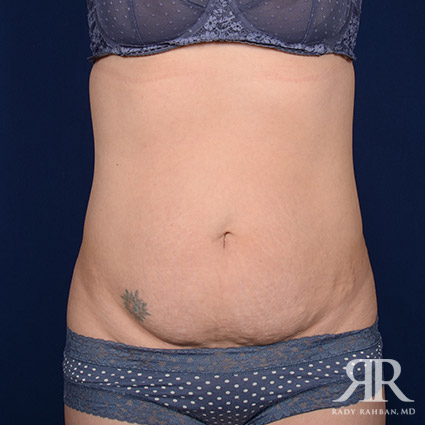 Tummy Tuck