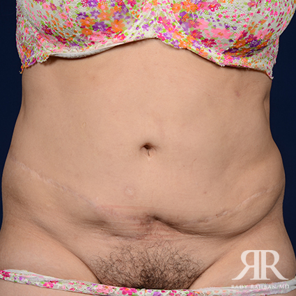 Tummy Tuck