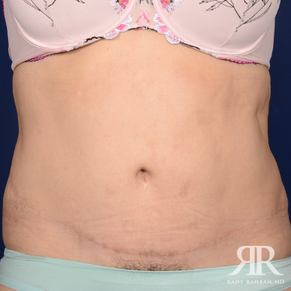Tummy Tuck