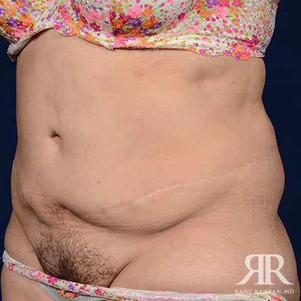 Tummy Tuck