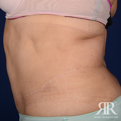 Tummy Tuck