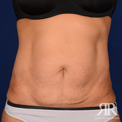 Tummy Tuck