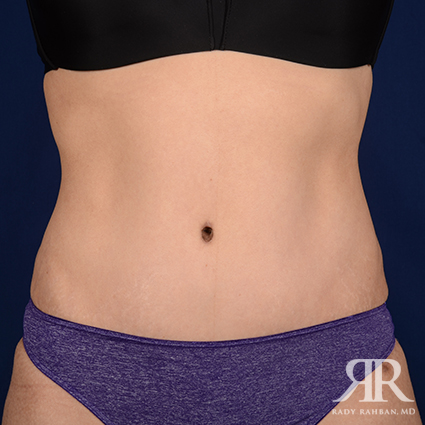 Tummy Tuck