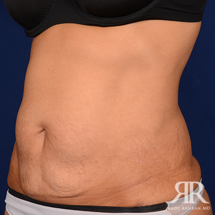 Tummy Tuck