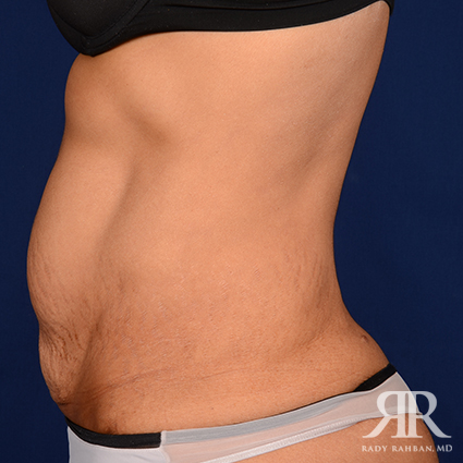 Tummy Tuck