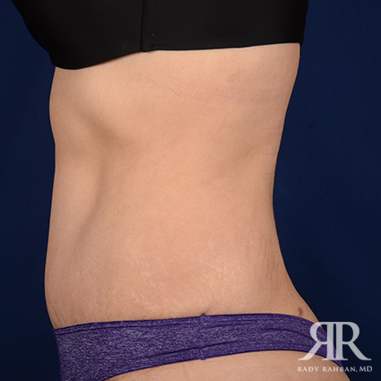 Tummy Tuck