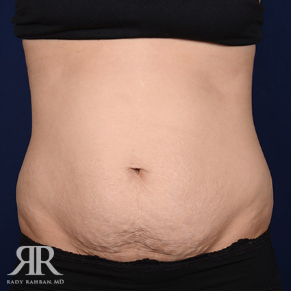 Tummy Tuck