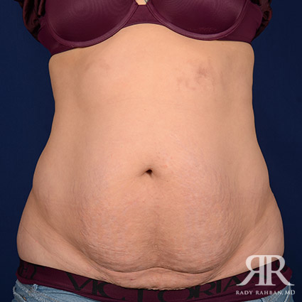 Tummy Tuck