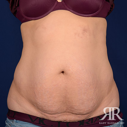 Tummy Tuck