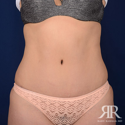 Tummy Tuck