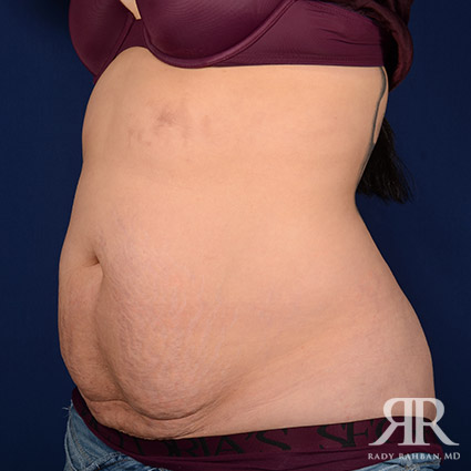 Tummy Tuck