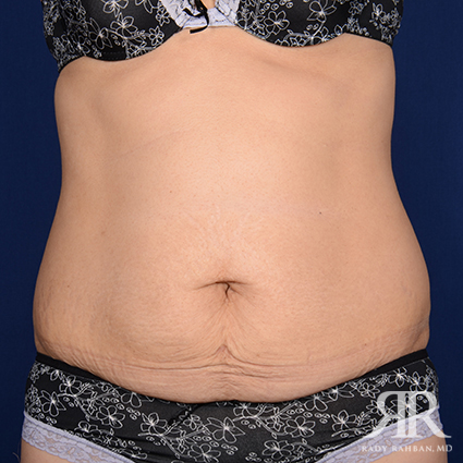 Tummy Tuck