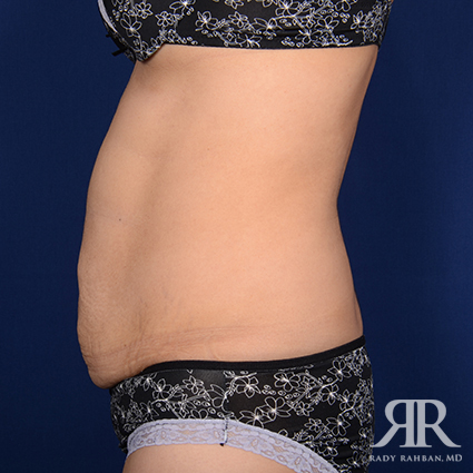 Tummy Tuck