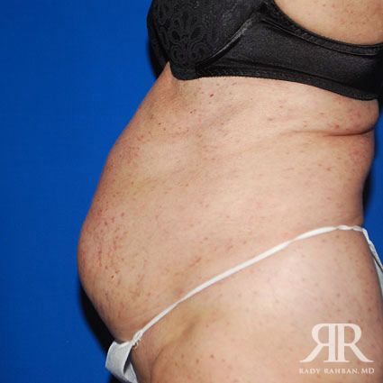 Tummy Tuck