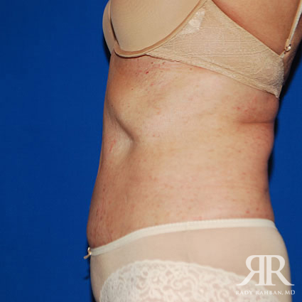 Tummy Tuck