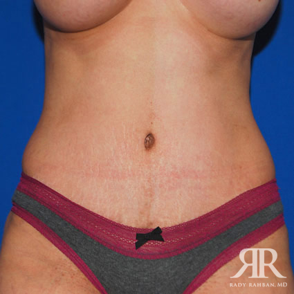 Tummy Tuck