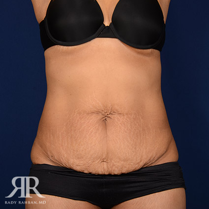 Tummy Tuck