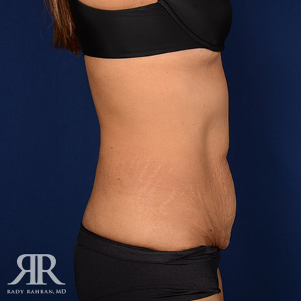 Tummy Tuck