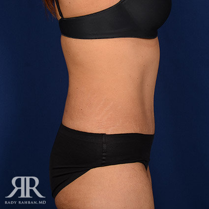 Tummy Tuck