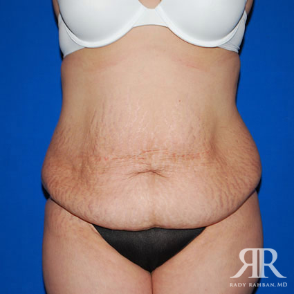 Tummy Tuck