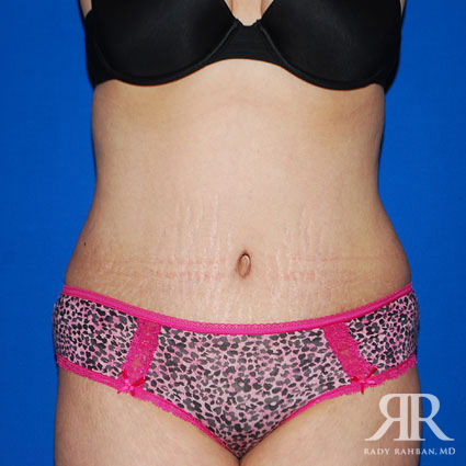 Tummy Tuck